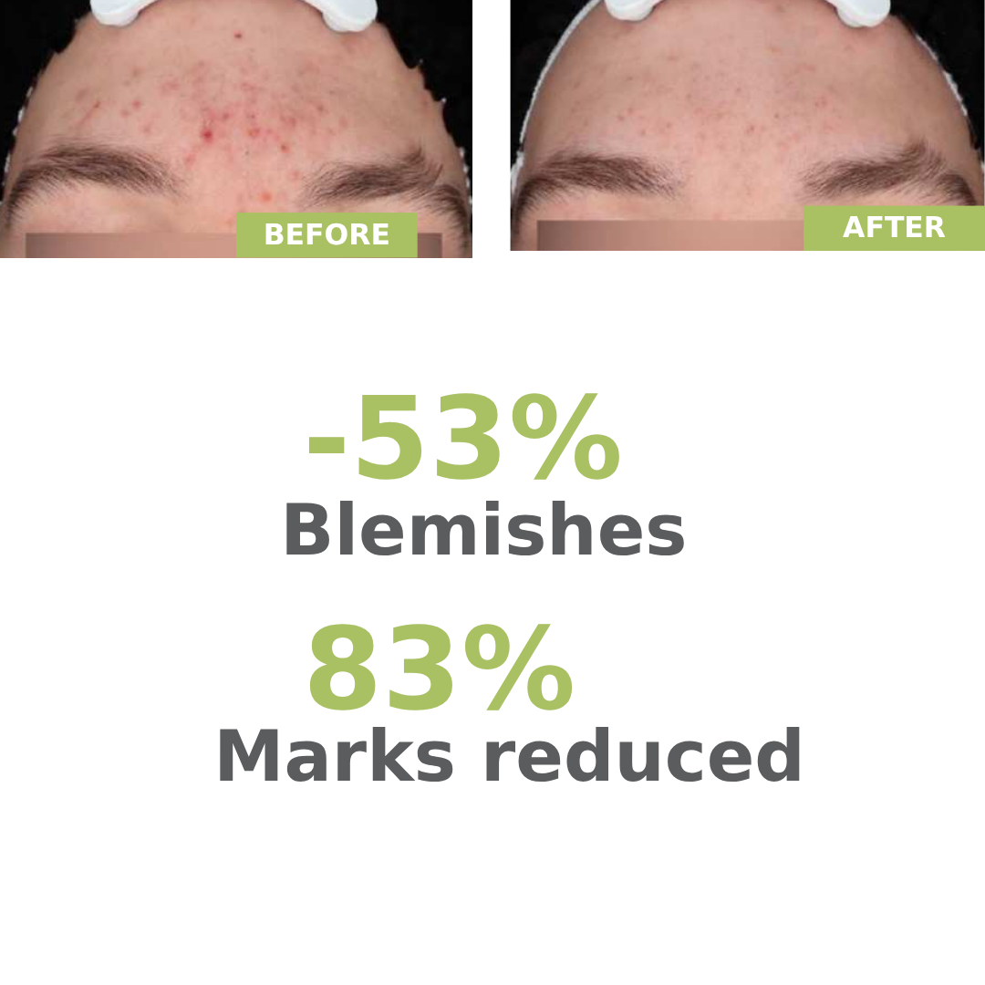 A-derma Biology AC Night Peel Anti-Blemish Serum 30ML — image 6
